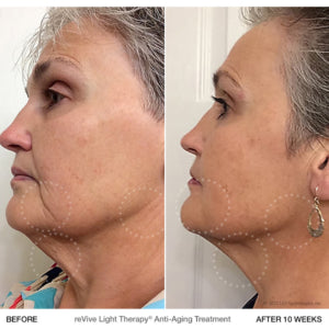 reVive DPL IIa LED Light Therapy Treatment Panel for Acne